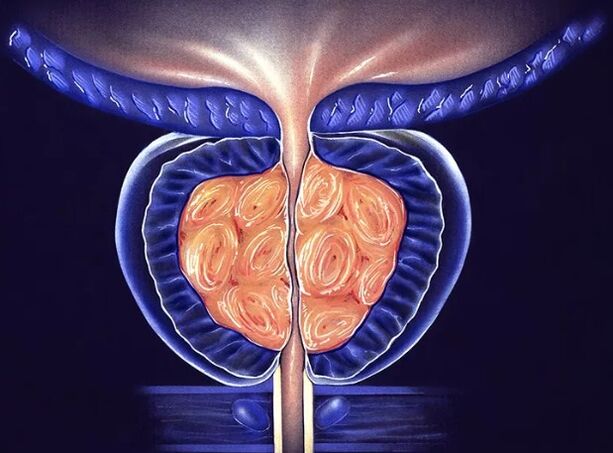 Chronic bacterial prostatitis