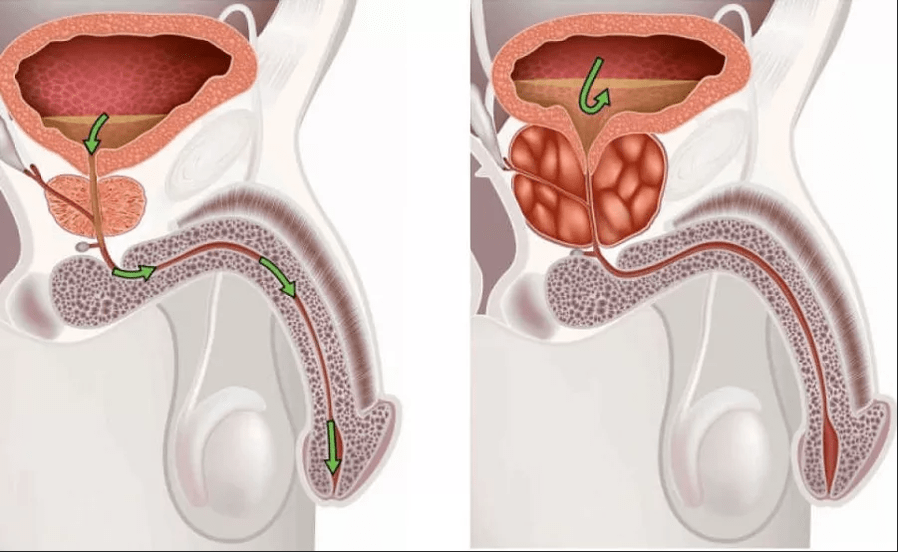 Symptoms of prostatitis